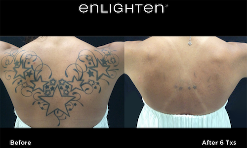 laser tattoo removal before after mississauga oakville